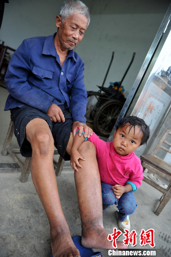 抗戰勝利69周年:探訪江西萬家嶺戰役毒氣受害老人